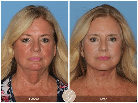 Deep Plane Facelift Orange County - Newport Beach California