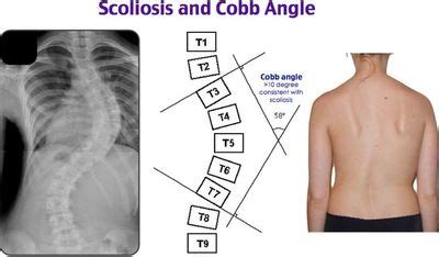 FAQs | Scoliosis Therapeutic Care