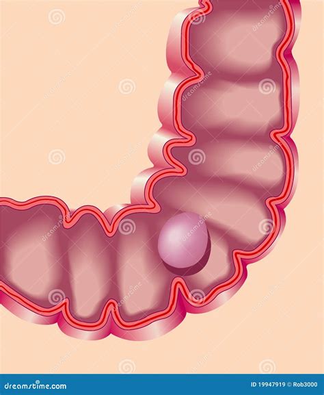 Polyps In Colon Different Types at Roxanne Corley blog