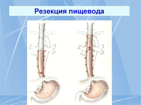 Опухоли пищевода и желудка - презентация онлайн