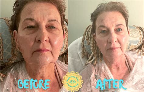 infrared thermal facelift anti aging treatment  villages fl