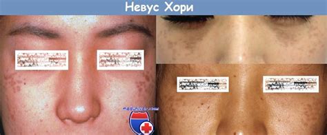 Невус Хори