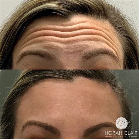 Botox Vs. Fillers: Dermatologists on the Difference Between the ...