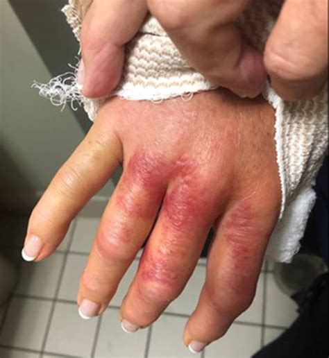 Flesh Eating Disease Beginning