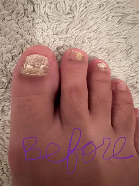 My disgusting horrible no good nail fungus, can you see a difference
