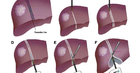 Laparoscopy: Purpose, Procedure & Recovery: Liver resection Surgery