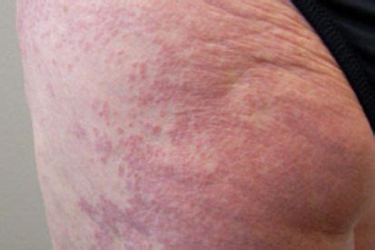 Diabetes-Related Skin Conditions and Treatment | Brentwood Dermatology