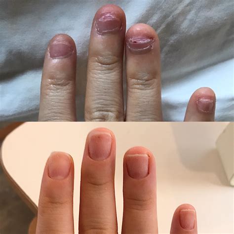 [TW] Personal Worst vs Best - Nail beds do reattach!!! : r/calmhands