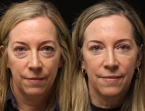 months   blepharoplasty surgery