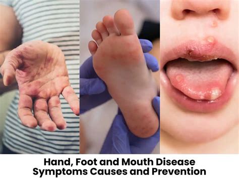 Dominica Ministry of Health Confirms HFMD On Island