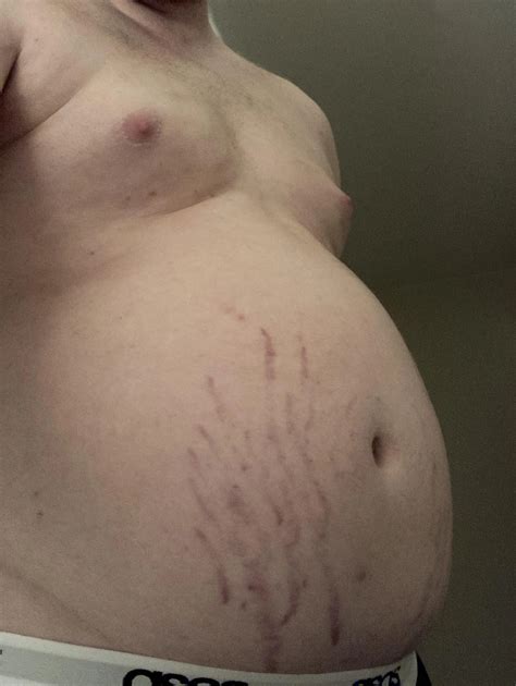 What do you think of my stretch marks ? | Scrolller