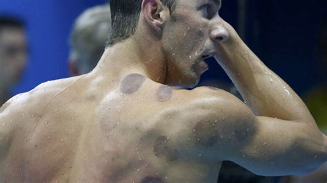 What is Cupping Therapy and What Are The Benefits - Glasgow Premier ...