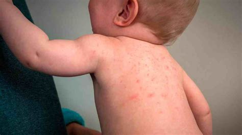 Alergia De Pele Bebe - Alergia na pele de bebê: causas, sintomas e tratamentos