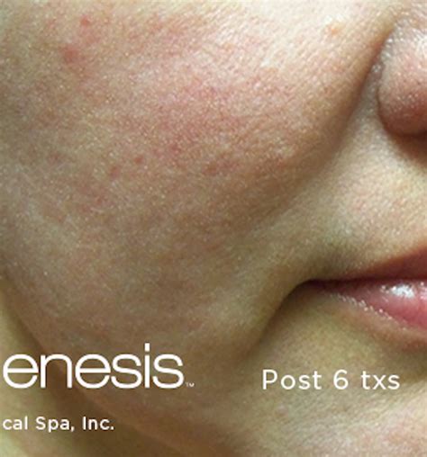 Before & After Laser Genesis in Woodland Hills | EllEve MedSpa