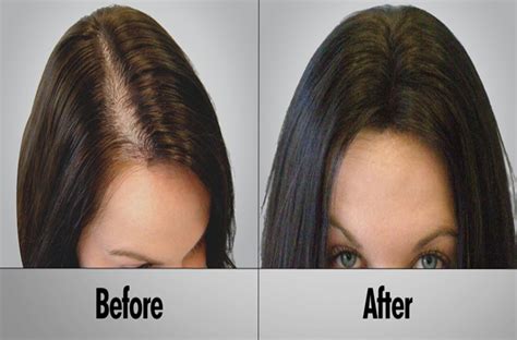 hair loss treatment  female hair styles color ideas