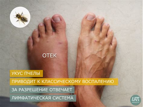 Почему опухает нога после солевой ванны - 80 фото