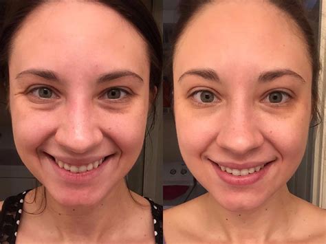 Vitamin C Serum Before And After Dark Skin | informacionpublica.svet.gob.gt