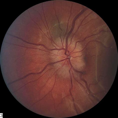 With grade 2 papilledema the halo becomes circumferential. | Download ...