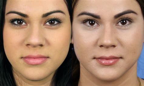 Alectomia Antes E Depois - Alectomia Nasal - Renovarte Beauty Center
