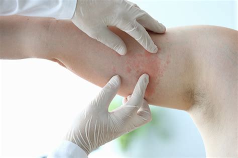 Possible Causes of Skin Chafing & Treatment Options