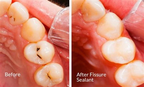 Dental Sealants - RRDCH