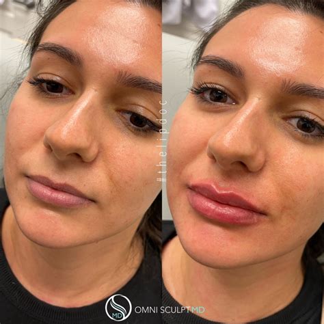 What does 1 syringe of filler do for the lips? 1 syringe of filler adds