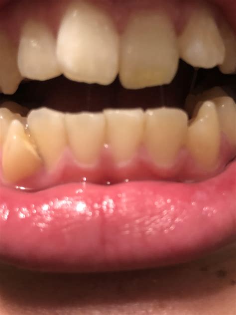 Loose teeth sensation caused by plaque? 25 M non smoker and I don't