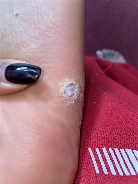 Is my wart/verruca dead? : r/Warts
