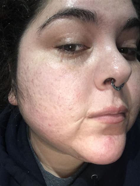 28f always had difficult skin and have been trying for years to get my