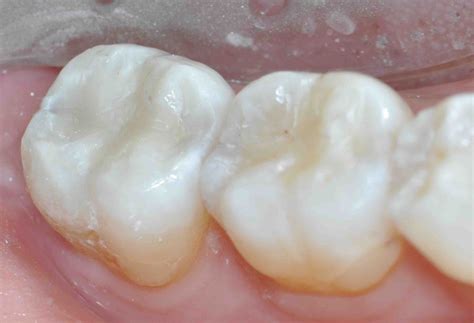 Posterior Composites: We Love Them and Hate Them - Lee Ann Brady, DMD's