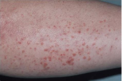 Erythema Elevatum Diutinum - Two Case Reports, Two Different Clinical ...