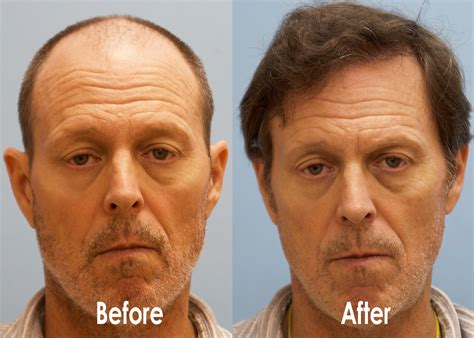 FUE Hair Transplant Results at 6 & 18 Months Post-Op - Carolina Hair