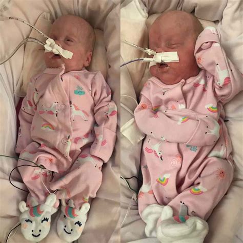 Identical Micro-Preemie Twin Babies Born at Iowa Hospital