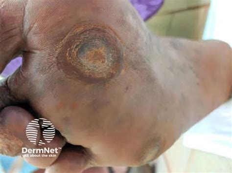 Why Diabetes Can Cause Dark Spots on Your Legs | DiabetesTeam