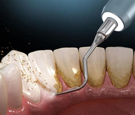 dental plaque      jennifer  xie dds cosmetic