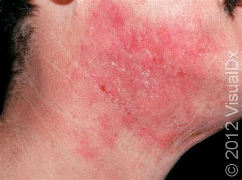 Severe Eczema On Face