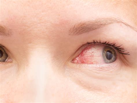 how to know if you have pinkeye