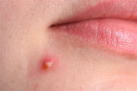 Doctors explain the biological process that occurs when popping big pimples 18