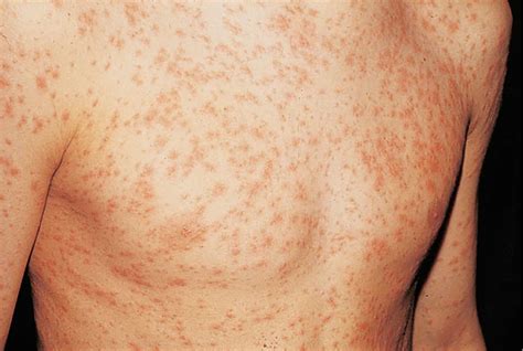 Skin Rash, Causes, Baby Skin Rash - Allergy, Fungal & Treatment