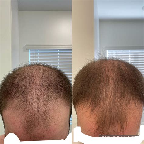 Coming up on 5 months fin/min spray : r/tressless