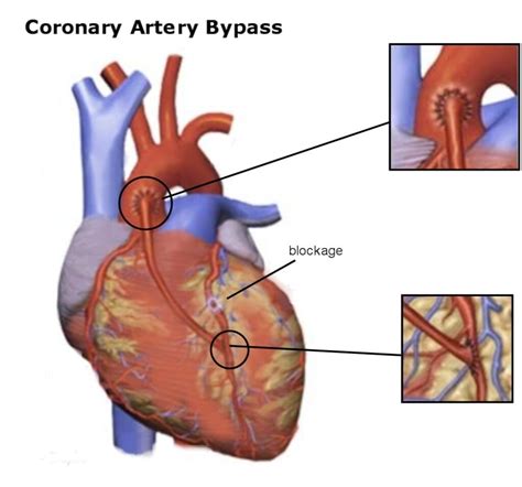 healthier  coronary artery bypass surgerycabg