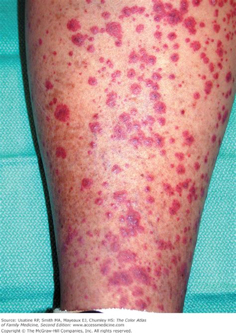 Vasculitis Symptoms