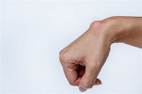 Ganglion - Healthtips by TeleMe