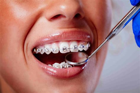 The Pros and Cons of Braces for Teenagers Explained in Detail 1