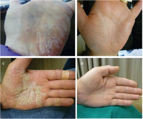 chronic hand dermatitis | Semantic Scholar