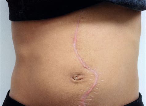 exploratory laparotomy khobragade multispeciality hospital