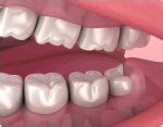 molars    lema dental clinic