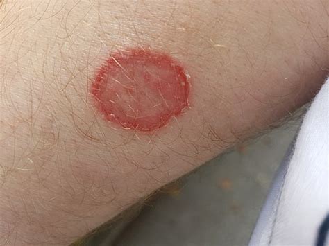 First Ever Drug-Resistant Ringworm Cases In US Identified By CDC ...