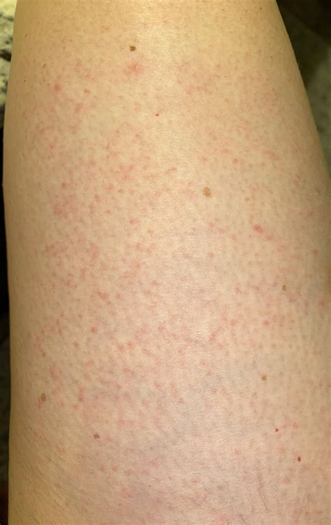 What are these itchy red bumps? : r/DermatologyQuestions