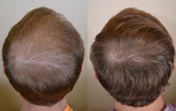 Finasteride Results: Timeline, Photos, Before & After